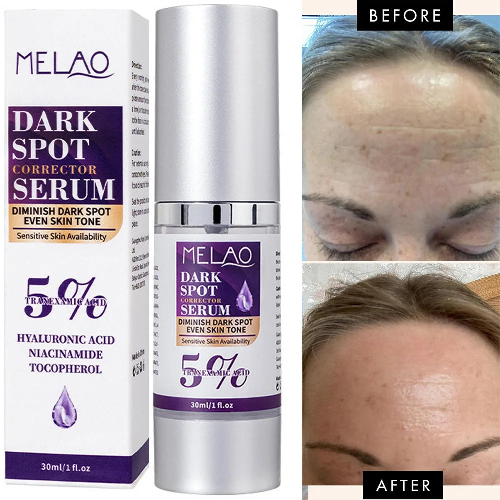 Dark Spot Remover for Face,Dark Spot Corrector Serum for Age Spot Sun Spot Freckles Melasma Brown Spot Skin Care Repair Cream Vue