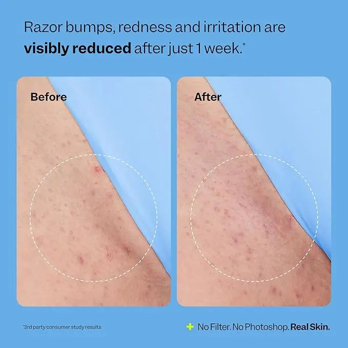 Smoothing Solution Hair Treatment (1.69 oz) - Smooth, Relieve, Soften Skin - 360 Roller - BHA, AHA, PHA, Niacinamide, Vegan Vue