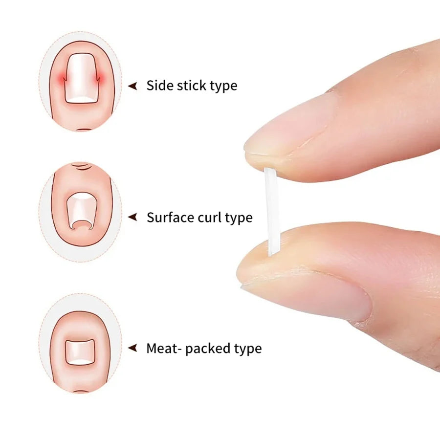 Elastic C-shaped Tube Pad for Toe Nail Ingrown Toenail Corrector Tools Foot Care Invisible Groove Straightening Clip Treatment Vue