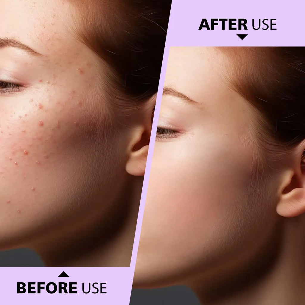 Teenitor Pimple Extractor Acne Treatment Tool Surgical Grade Blackhead Comedone Removal 2-in-1 Tool for Face Nose Blackhead Extr Vue