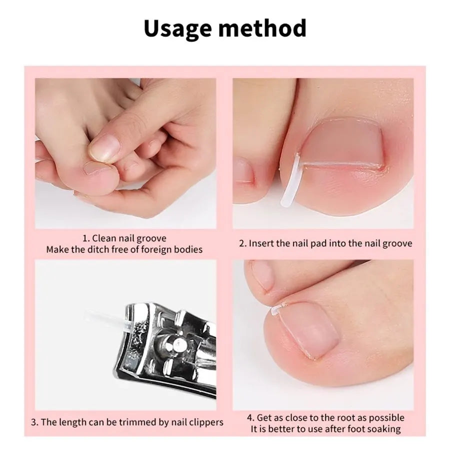 Elastic C-shaped Tube Pad for Toe Nail Ingrown Toenail Corrector Tools Foot Care Invisible Groove Straightening Clip Treatment Vue