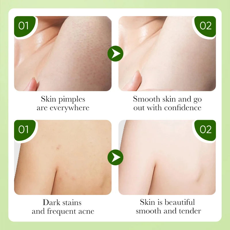 Cleansing, Bathing, Exfoliating, Gentle Cleansing, Oil-Controlling Essential Oil Soap, Rich in Foam, Easy to Rinse, Deeply Cleanses Skin Oils and Dirt, Cleanses the Skin and Removes Mites, Leaving Skin Refreshed and Comfortab Vue