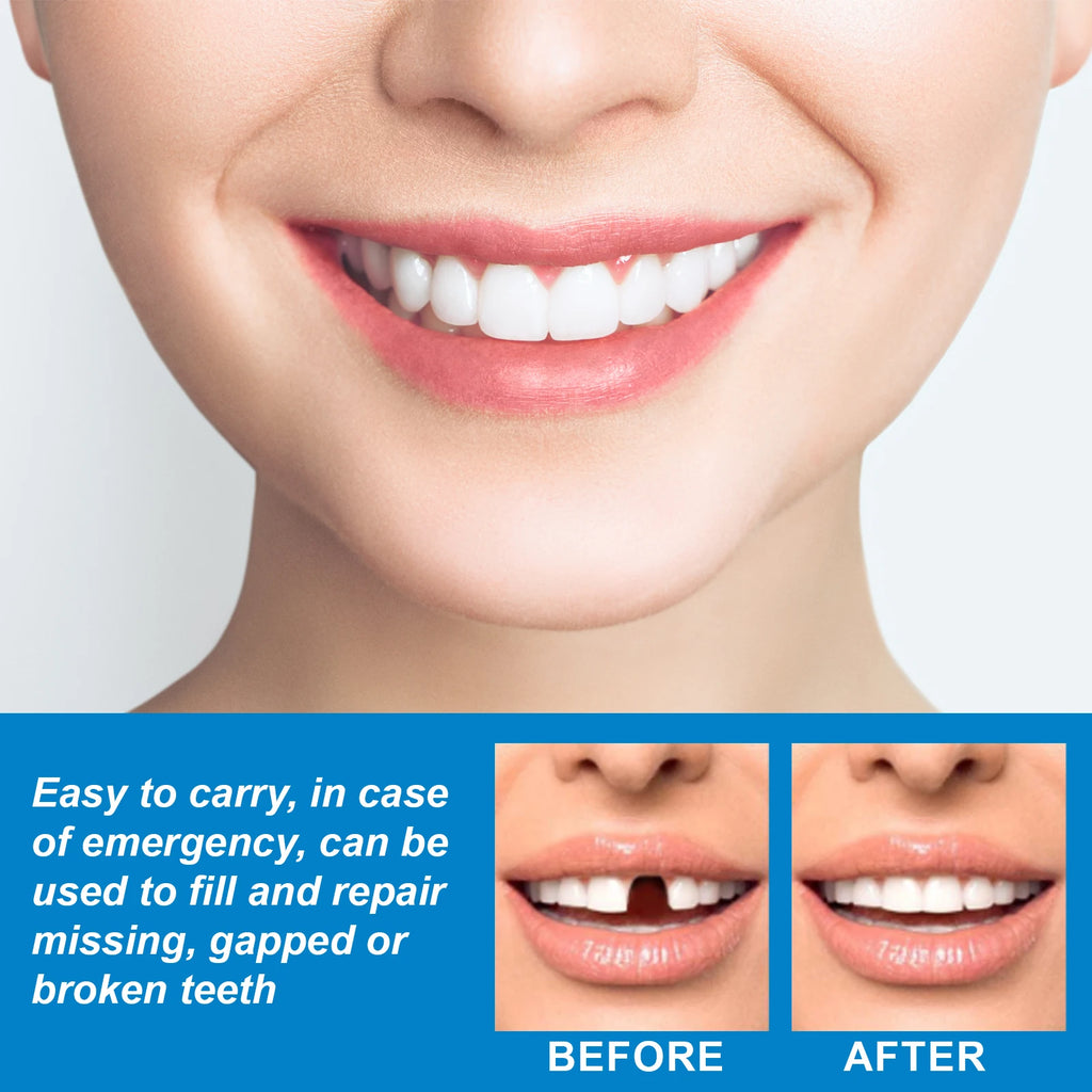 Temporary Tooth Repair Kit for Halloween Makeup, Fix Gaps, Cavities and Broken Teeth with Moldable Dental Resin Vue