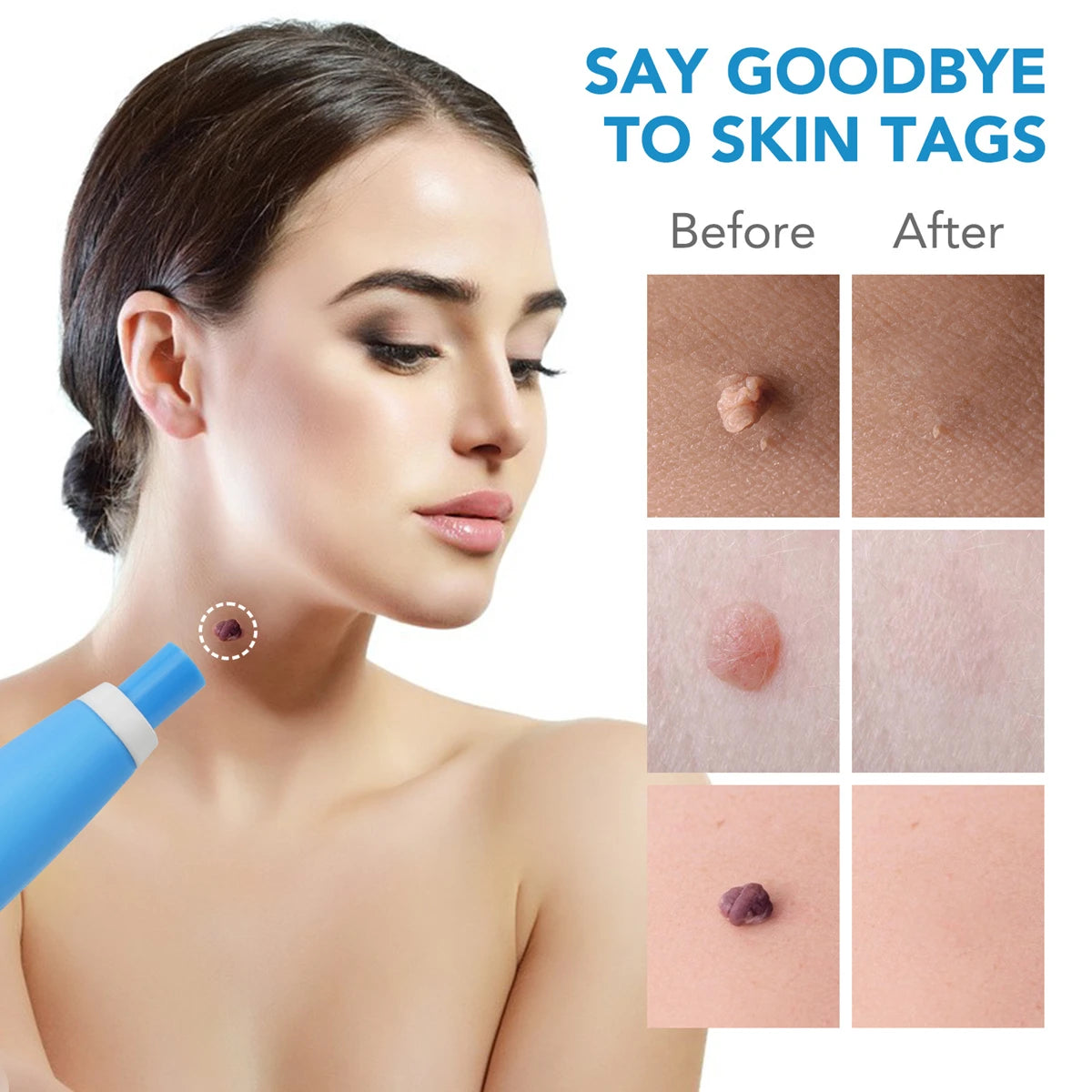 2 In1 Painless Auto Skin Tag Mole Wart Removal Kit Cleaning Tools Vue
