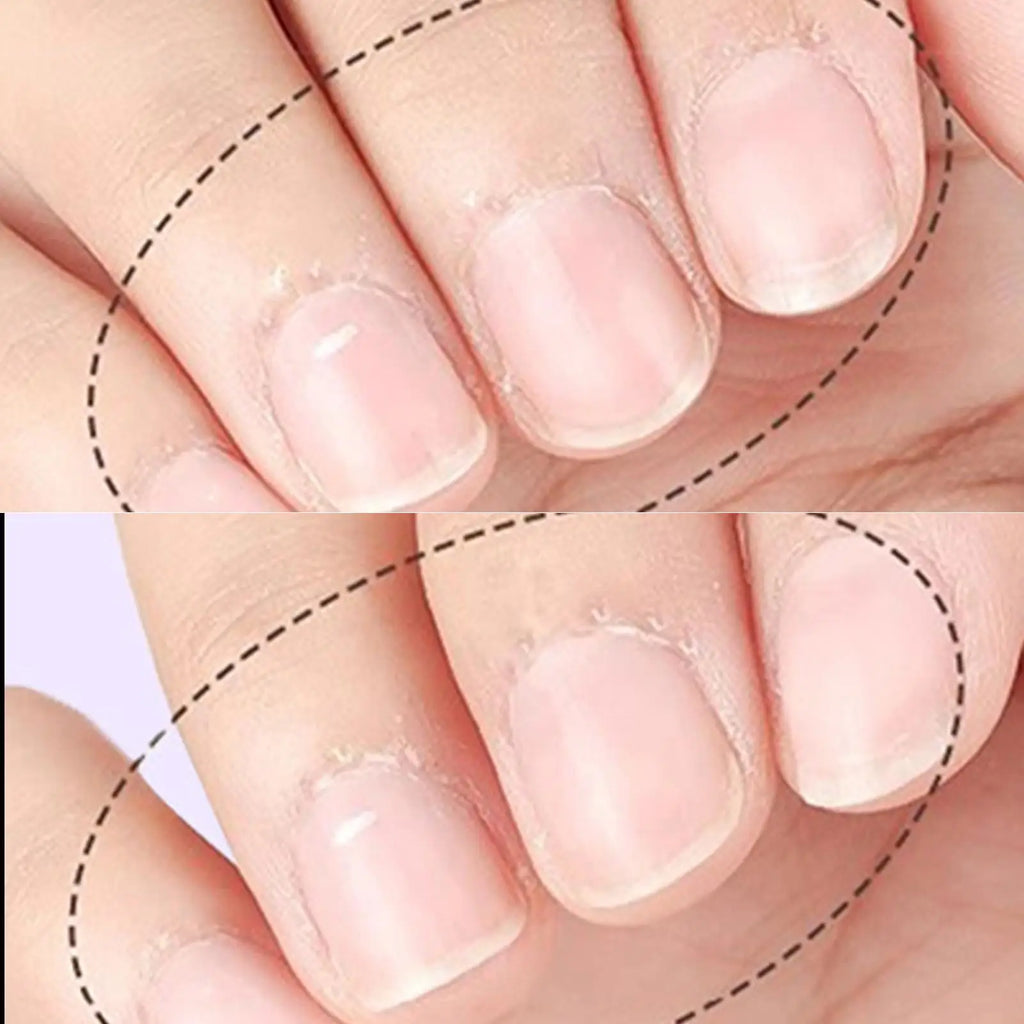 Nail Strengthener Damaged Nail Care Chip-resistant Cuticle Remover Pen for Nourishing Split Cracked Youth Weak Thin Men Elderly Vue